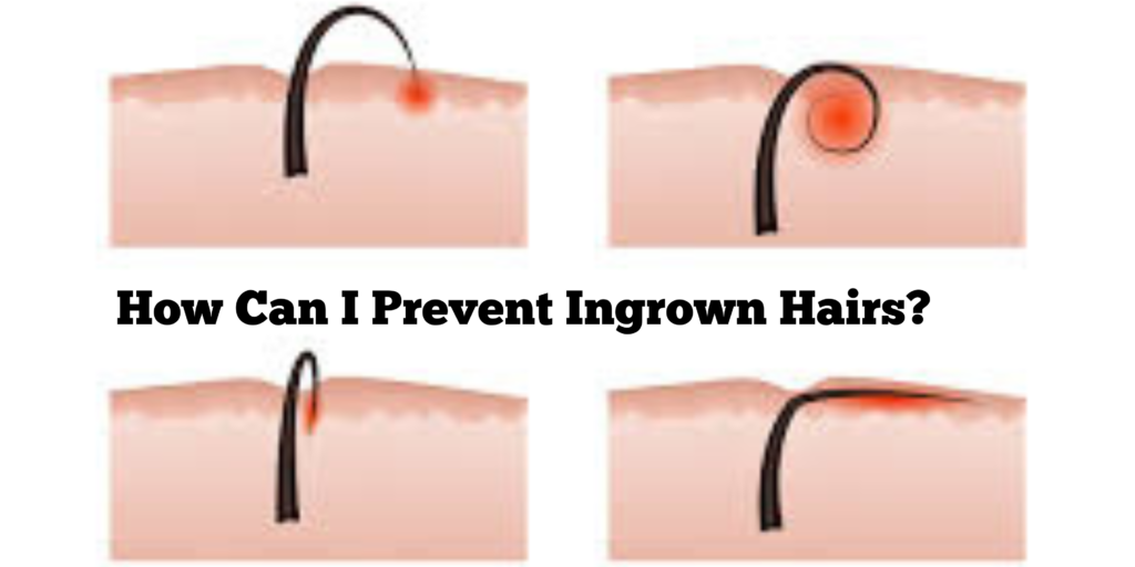 how to prevent ingrown hairs with proper shaving and skincare routine