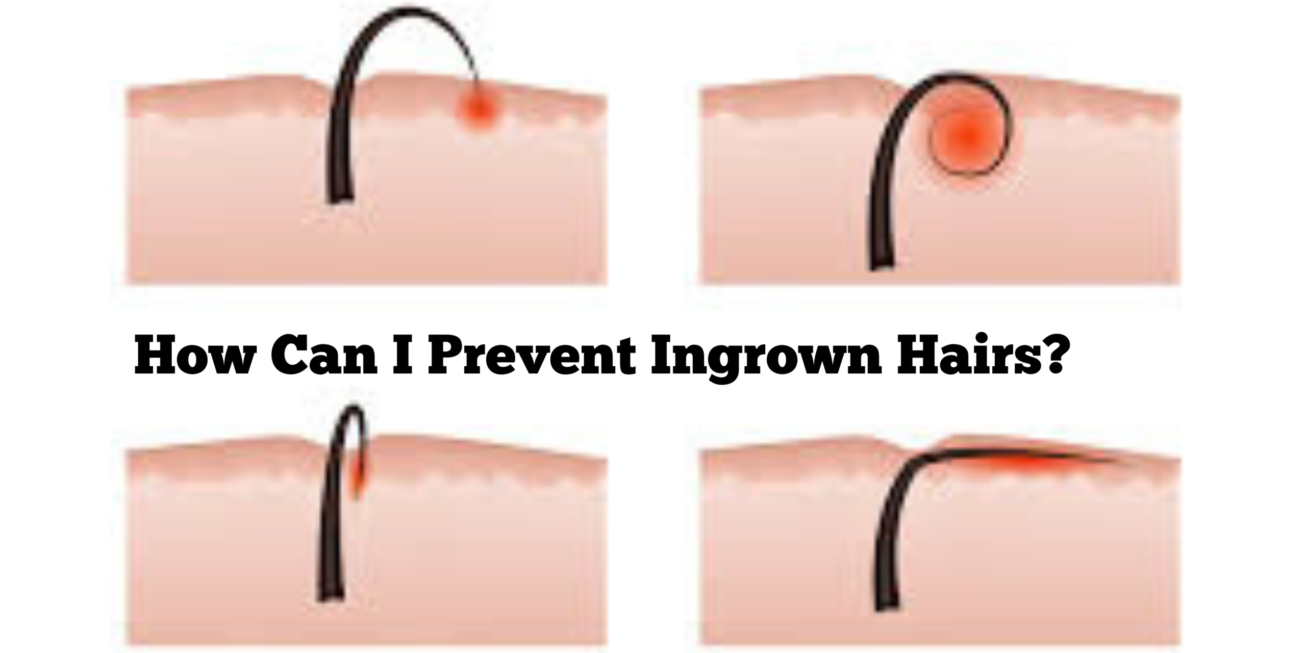 How Can I Prevent Ingrown Hairs?