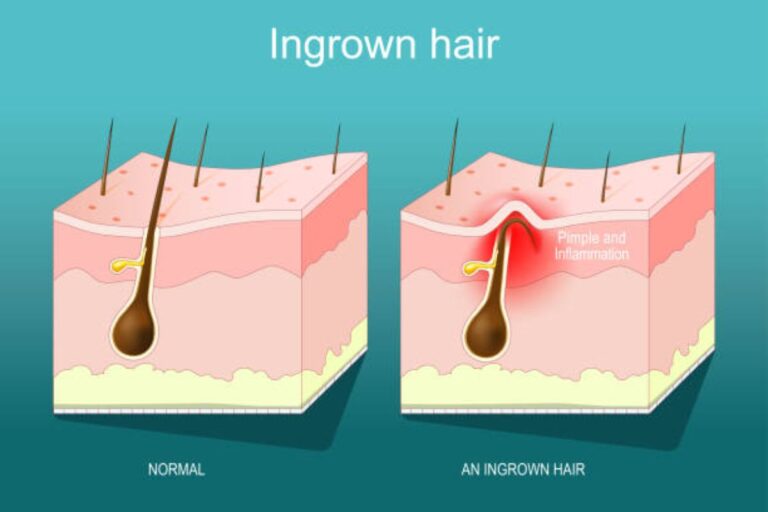 ingrown hairs