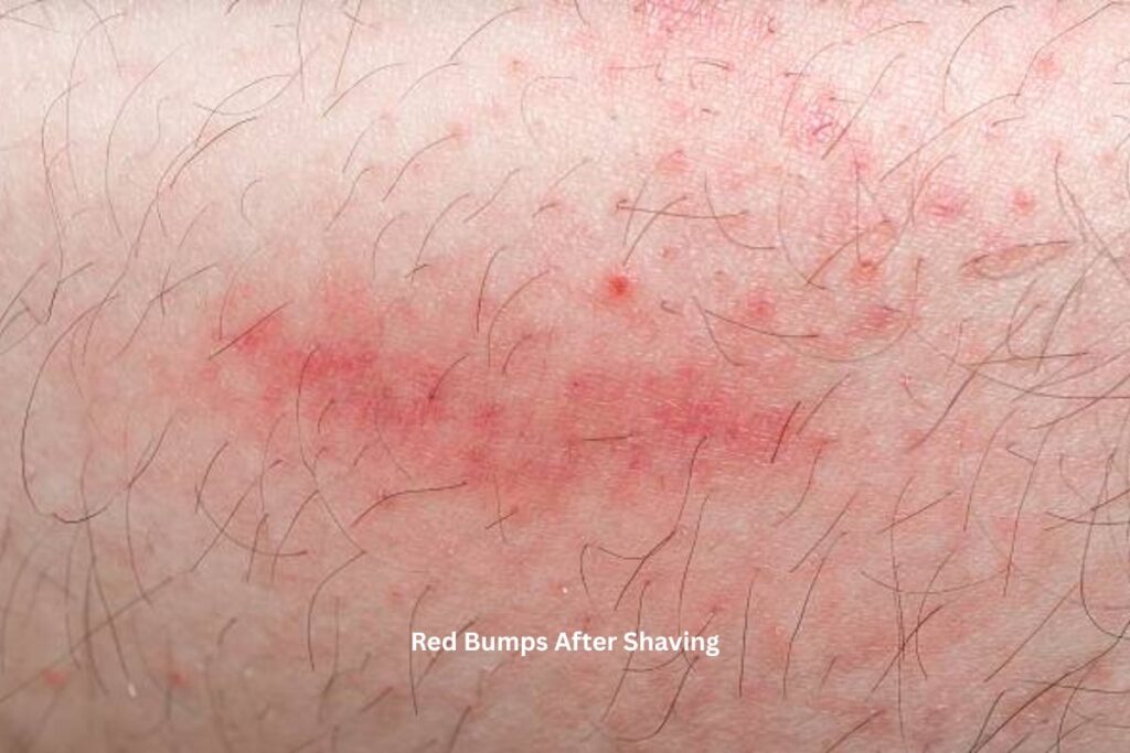 Red Bumps After Shaving