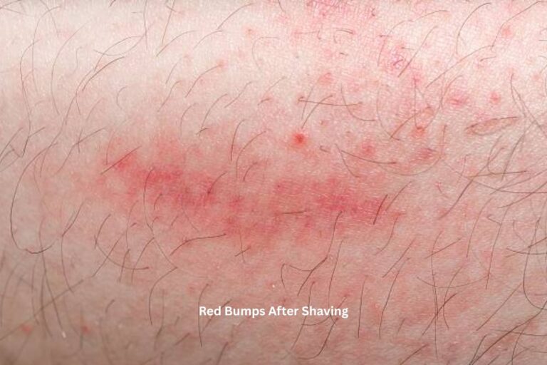 Red Bumps After Shaving