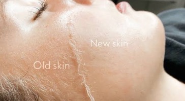 Dermaplaning