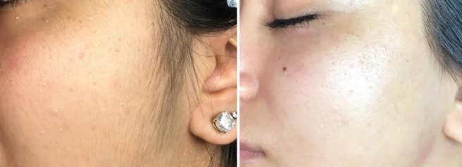 How Long Does Dermaplaning Last
