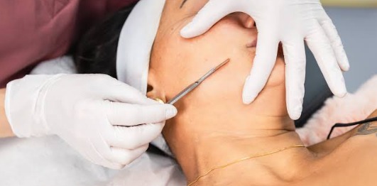 Dermaplaning Chicago IL